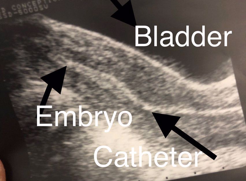 ultrasound scan of implantation