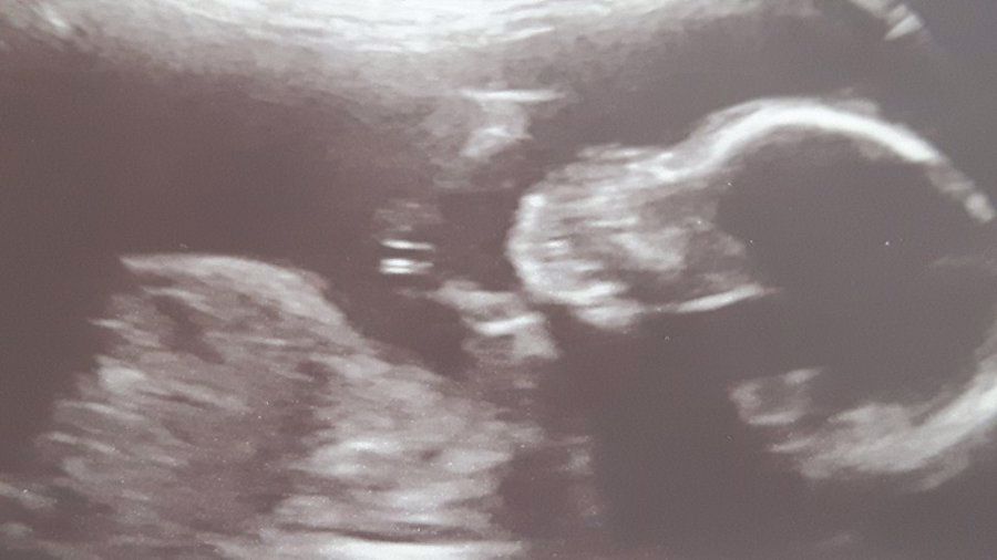Amie Henderson baby scan